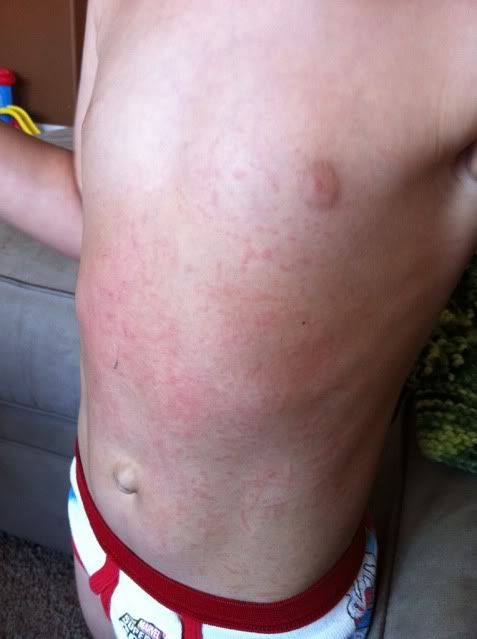 Ammonia Rash