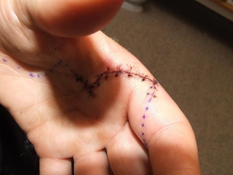 https://i112.photobucket.com/albums/n193/Warlord_Malice/Injuries/Surgery_handcut.jpg